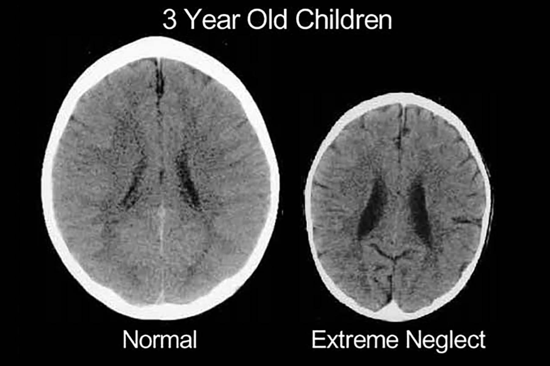 171102-toddler-brain-scans-embed 171102-toddler-brain-scans-embed